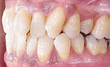 歯周病・予防治療