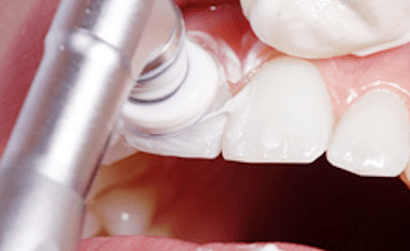 歯科衛生士による専門治療